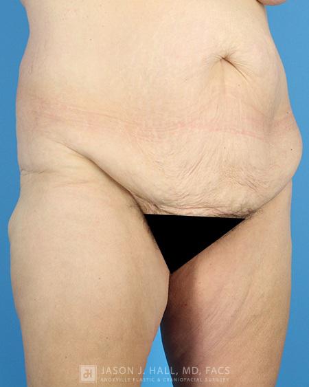 Arm-Lift and Thigh-Lift Before & After Image