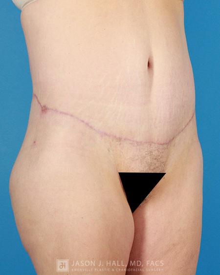 Arm-Lift and Thigh-Lift Before & After Image