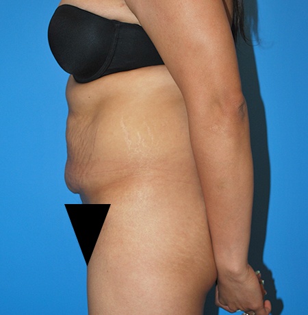 Tummy Tuck Before & After Image