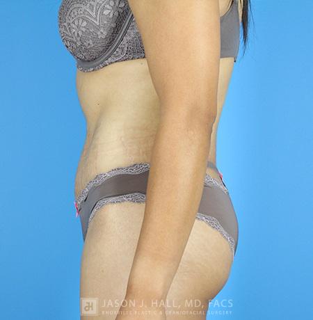 Tummy Tuck Before & After Image