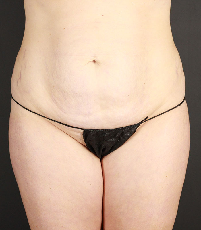 Tummy Tuck Before & After Image