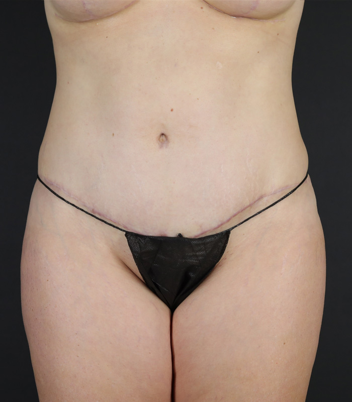 Tummy Tuck Before & After Image