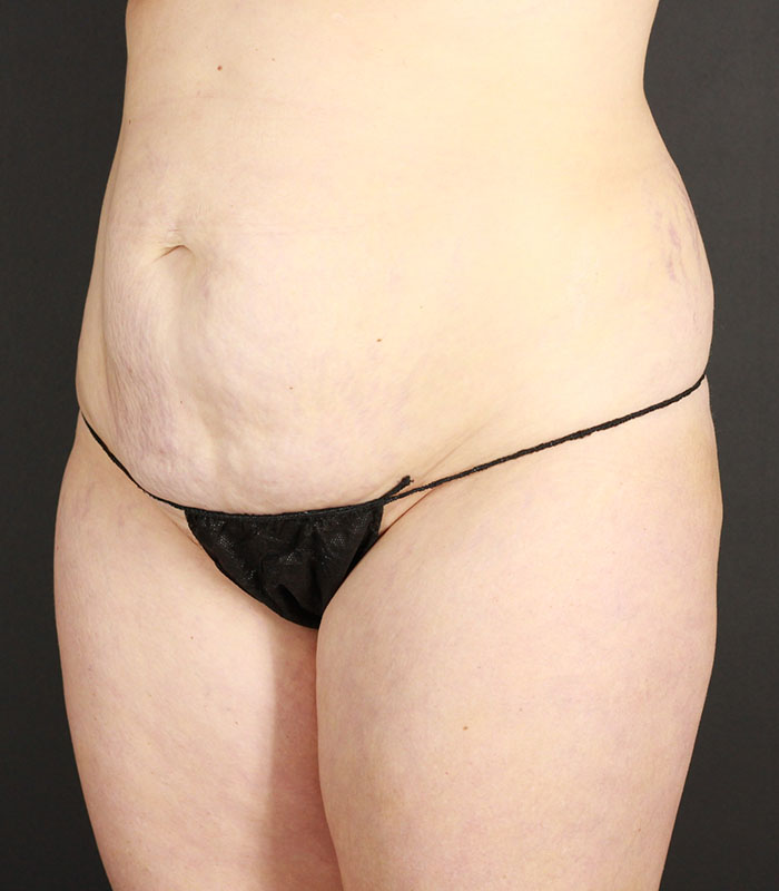 Tummy Tuck Before & After Image