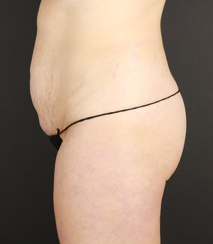 Tummy Tuck Before & After Image