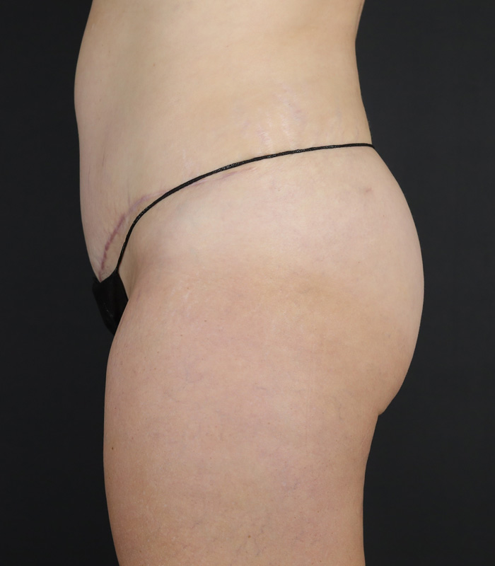 Tummy Tuck Before & After Image