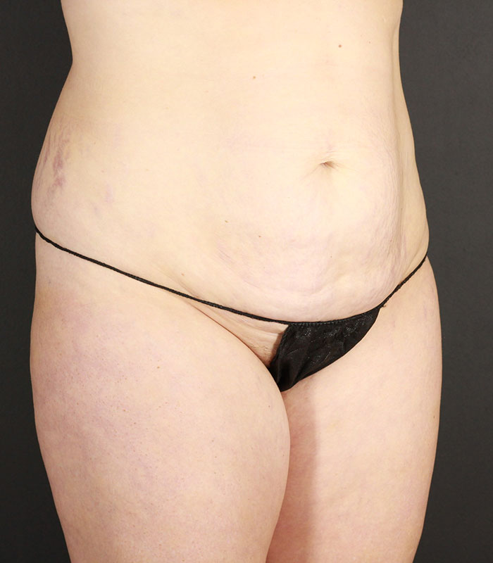 Tummy Tuck Before & After Image