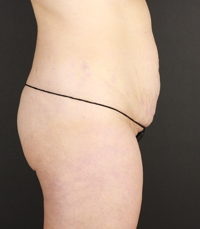 Tummy Tuck Before & After Image