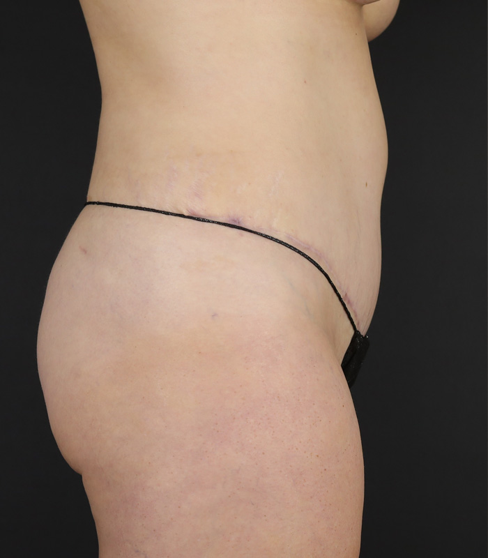 Tummy Tuck Before & After Image