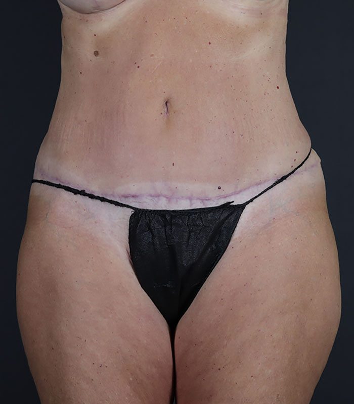 Tummy Tuck Before & After Image