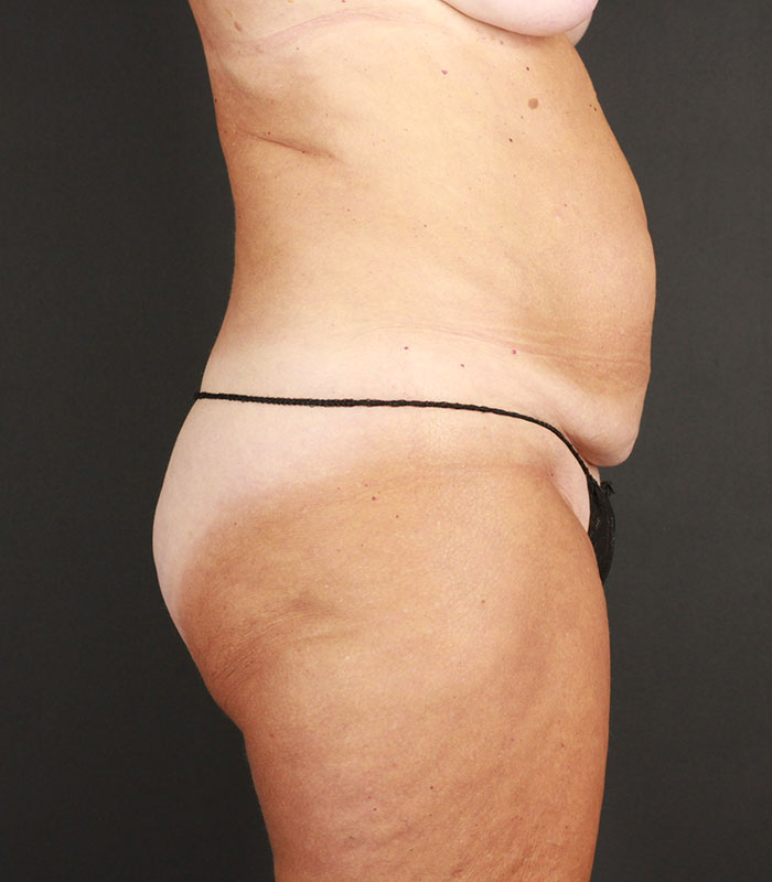 Tummy Tuck Before & After Image