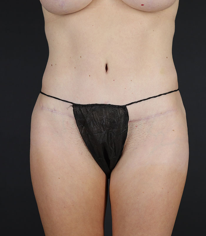 Tummy Tuck Before & After Image