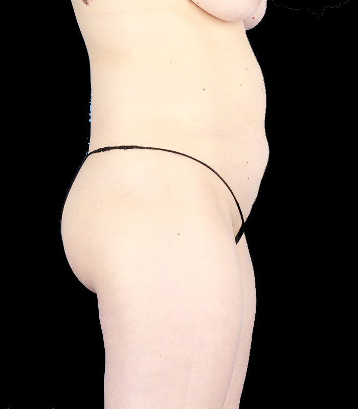 Tummy Tuck Before & After Image