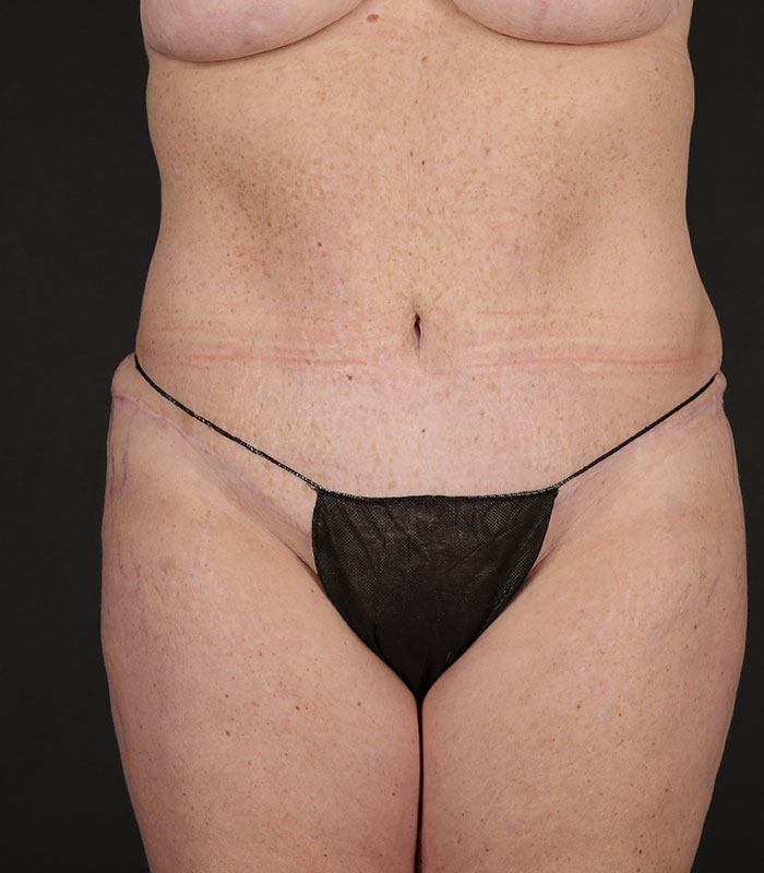Tummy Tuck Before & After Image