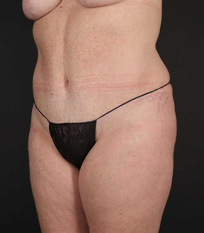 Tummy Tuck Before & After Image