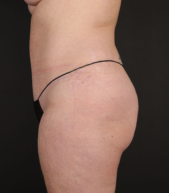 Tummy Tuck Before & After Image