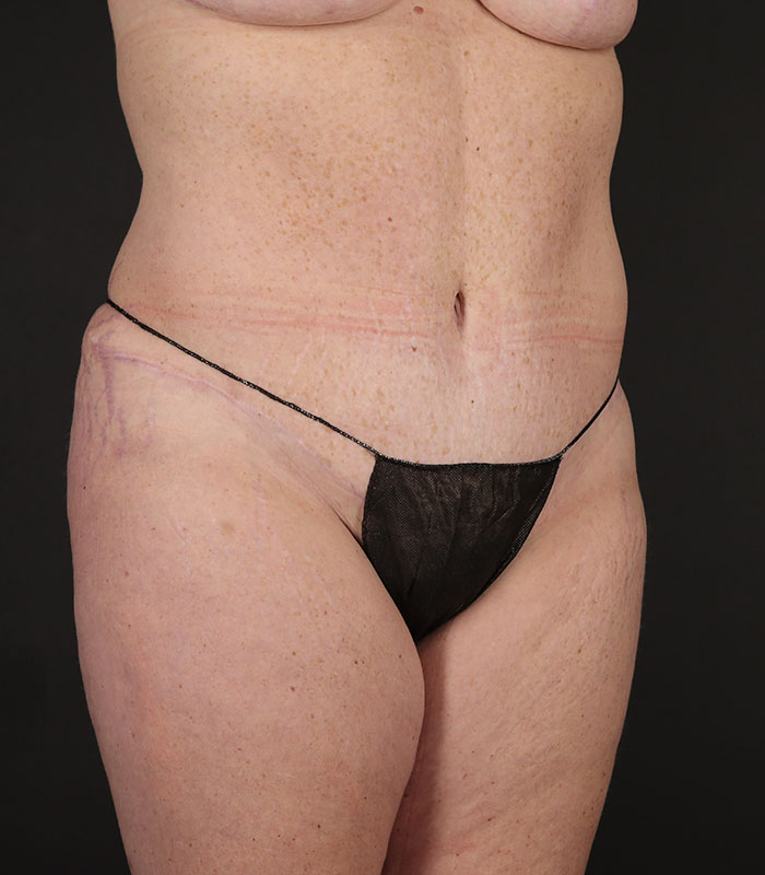 Tummy Tuck Before & After Image
