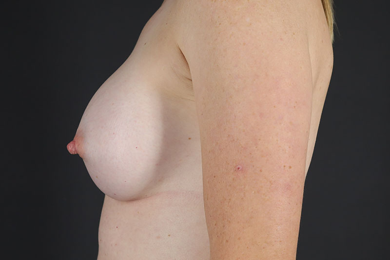 Breast Augmentation Before & After Image