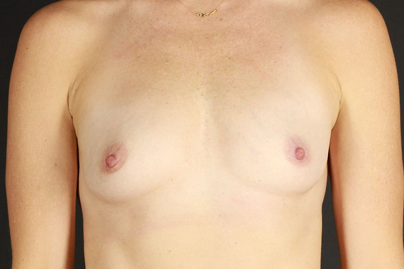 Breast Lift with Augmentation Before & After Image