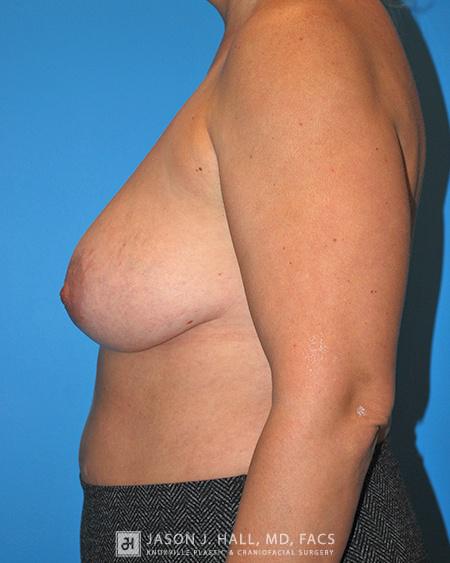Breast Lift with Augmentation Before & After Image
