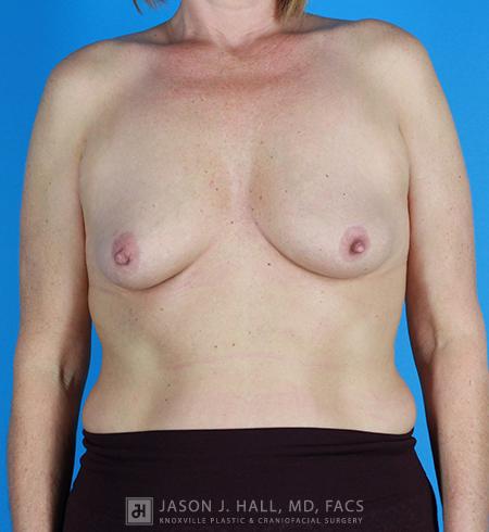 Breast Lift with Augmentation Before & After Image