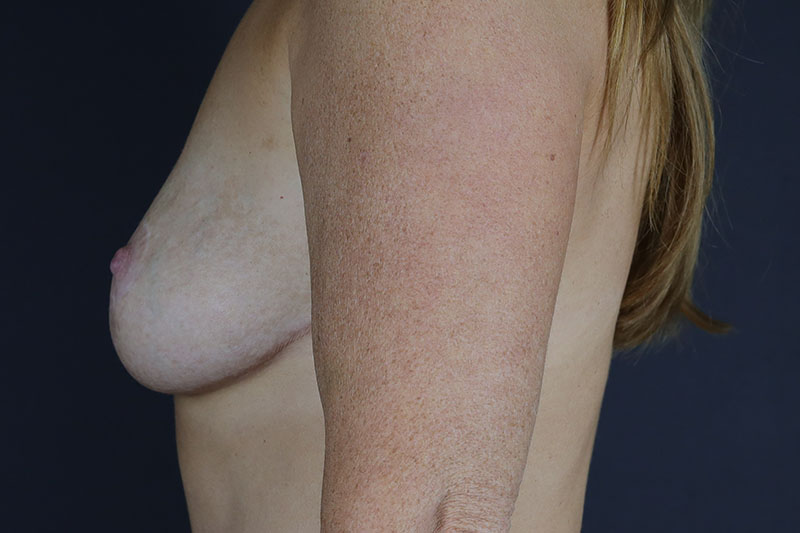 Breast Lift with Augmentation Before & After Image