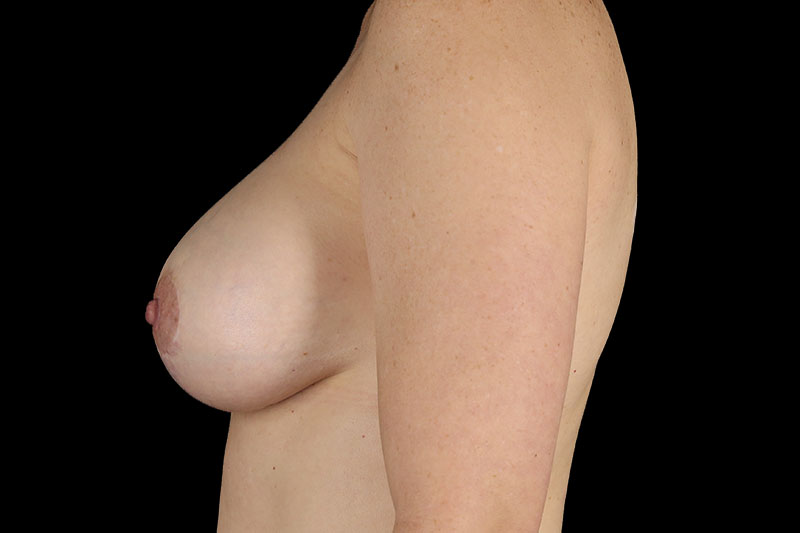 Breast Lift with Augmentation Before & After Image