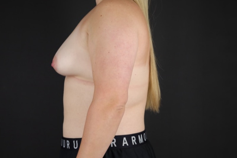 Breast Lift with Augmentation Before & After Image