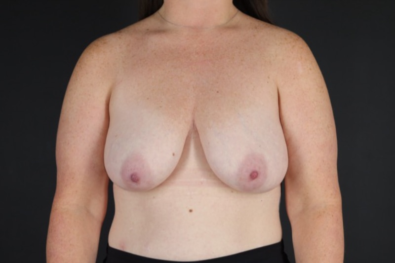 Breast lift with augmentation Before & After Image