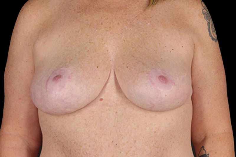 Breast Reduction Before & After Image