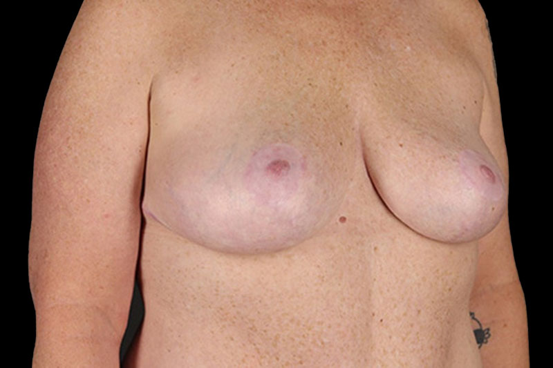 Breast Reduction Before & After Image