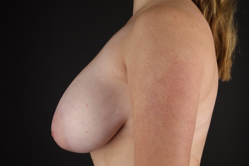 Breast Reduction Before & After Image