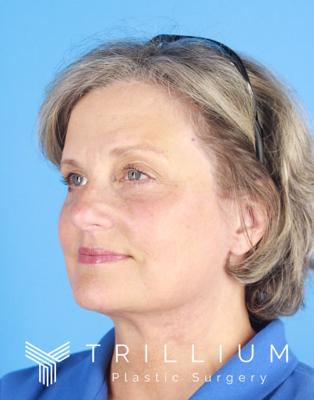 Blepharoplasty and Brow Lift Before & After Image