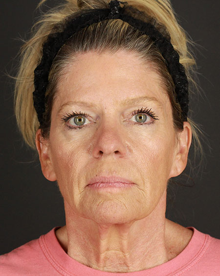 Blepharoplasty and Brow Lift Before & After Image