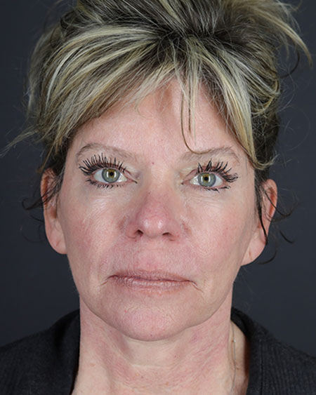 Blepharoplasty and Brow Lift Before & After Image