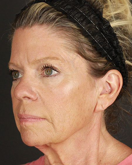 Blepharoplasty and Brow Lift Before & After Image