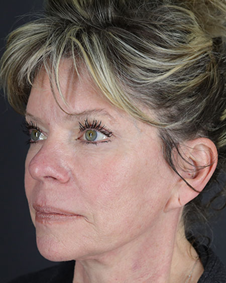 Blepharoplasty and Brow Lift Before & After Image