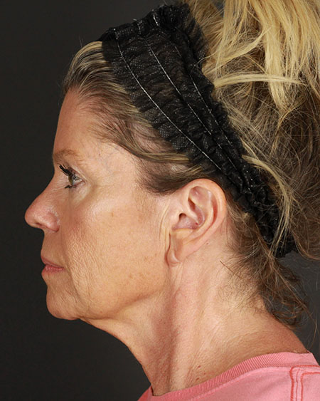 Blepharoplasty and Brow Lift Before & After Image