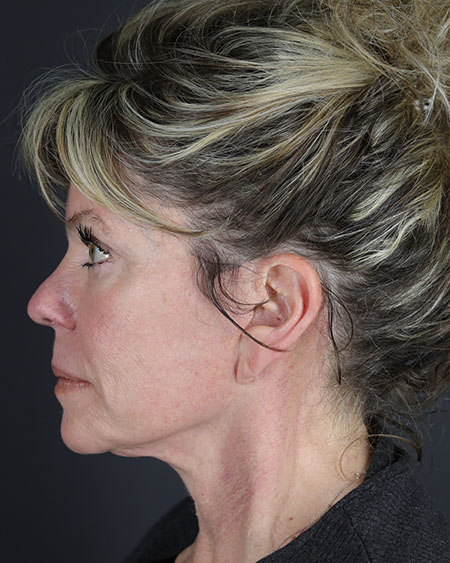 Blepharoplasty and Brow Lift Before & After Image