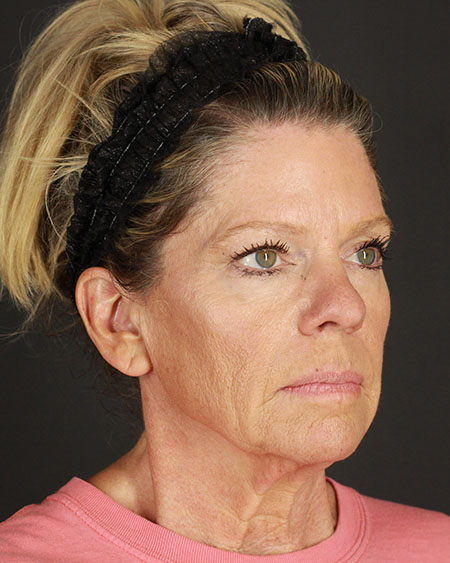 Blepharoplasty and Brow Lift Before & After Image