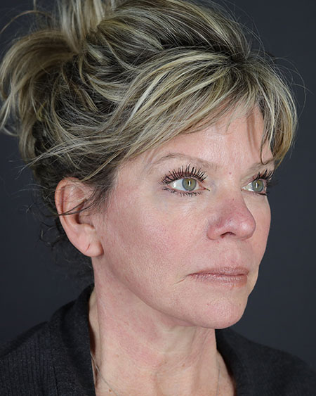 Blepharoplasty and Brow Lift Before & After Image
