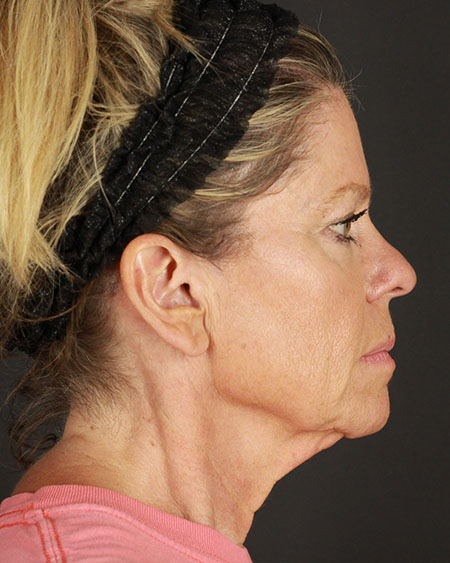 Blepharoplasty and Brow Lift Before & After Image