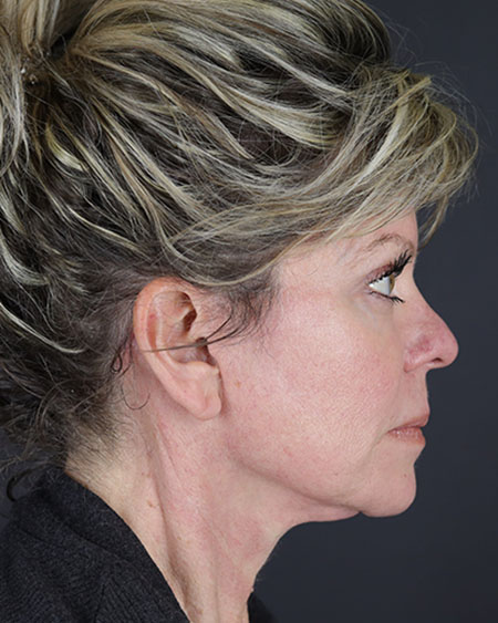 Blepharoplasty and Brow Lift Before & After Image