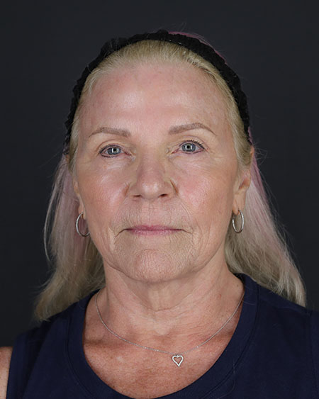 Blepharoplasty and Brow Lift Before & After Image