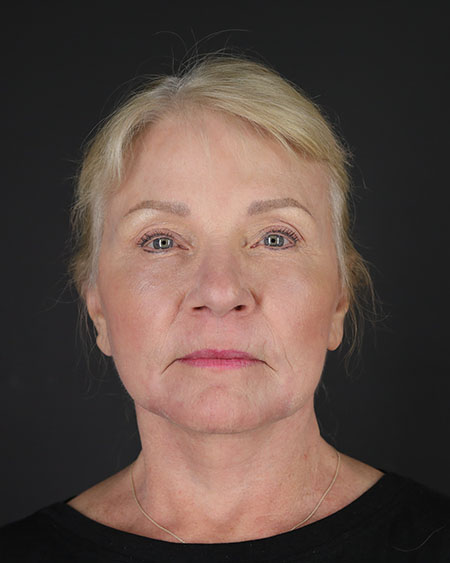 Blepharoplasty and Brow Lift Before & After Image