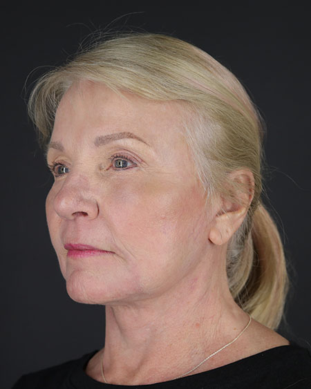 Blepharoplasty and Brow Lift Before & After Image