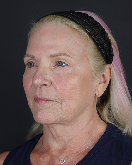 Blepharoplasty and Brow Lift Before & After Image