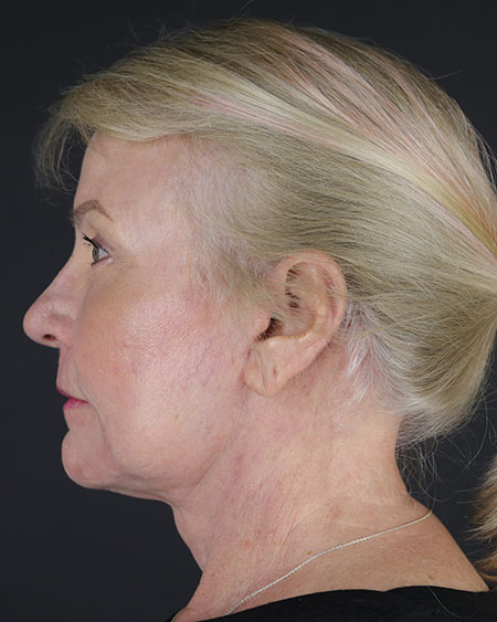 Blepharoplasty and Brow Lift Before & After Image
