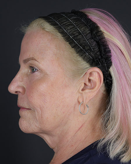 Blepharoplasty and Brow Lift Before & After Image