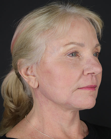 Blepharoplasty and Brow Lift Before & After Image