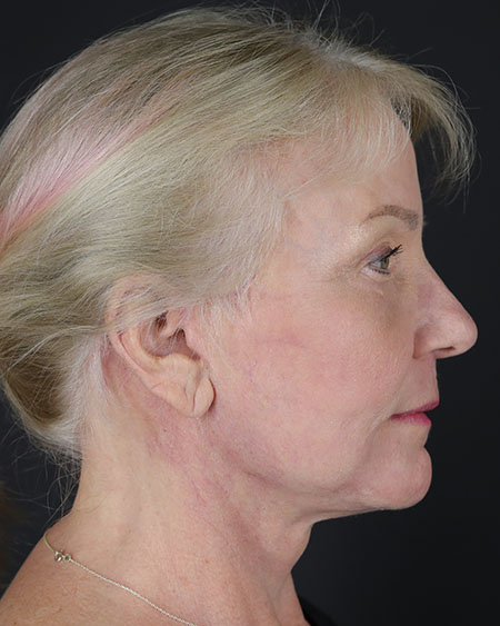 Blepharoplasty and Brow Lift Before & After Image